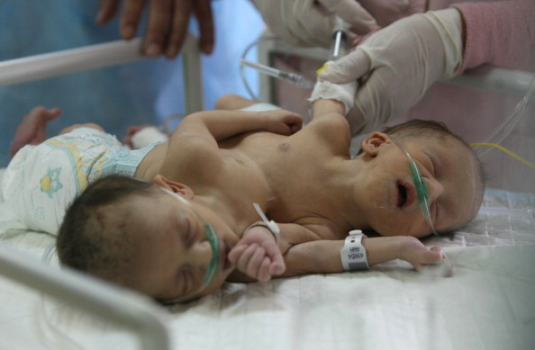 5 Fast Facts About Conjoined Twins